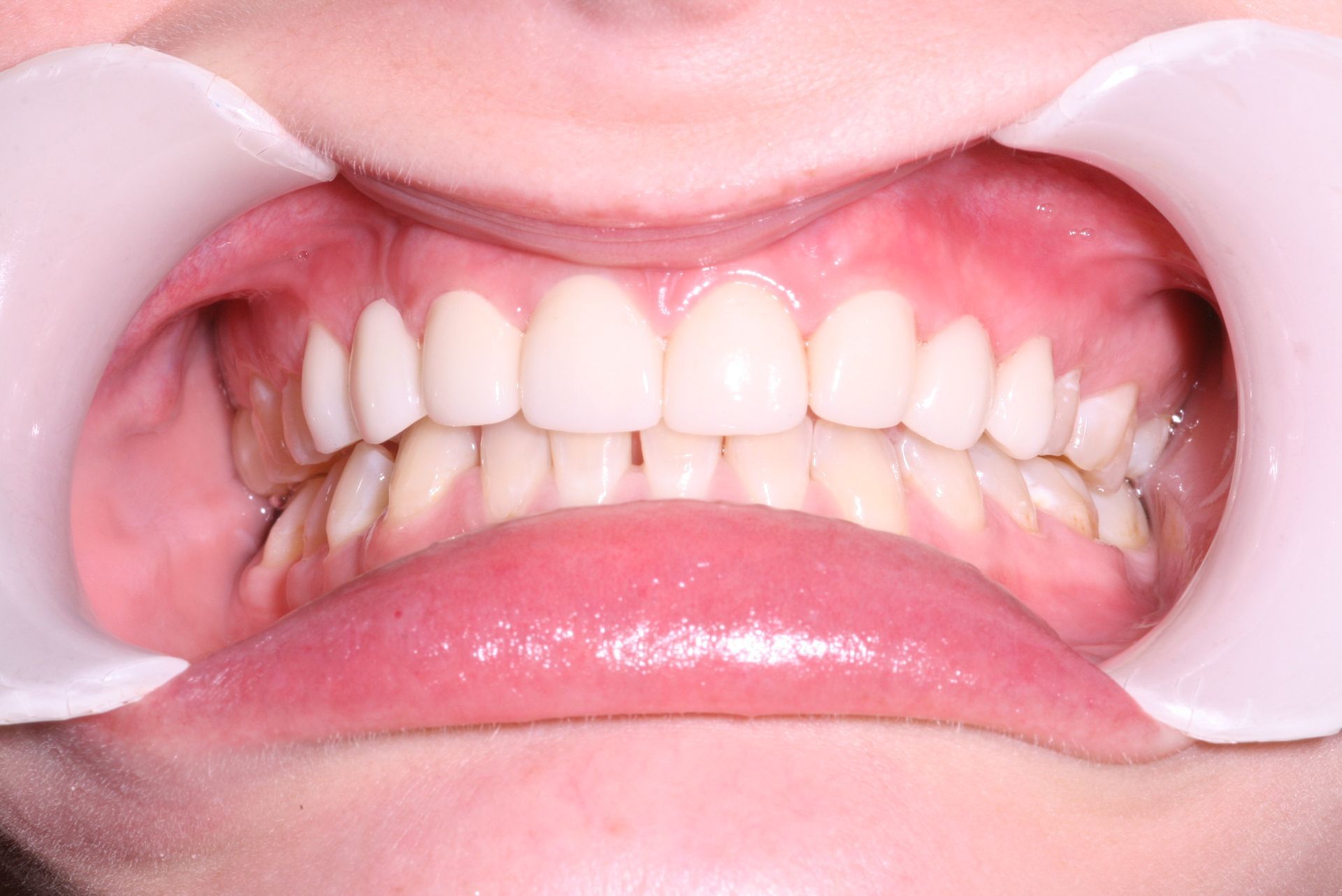 Close-up view of teeth and gums, light yellow teeth, pink gums.