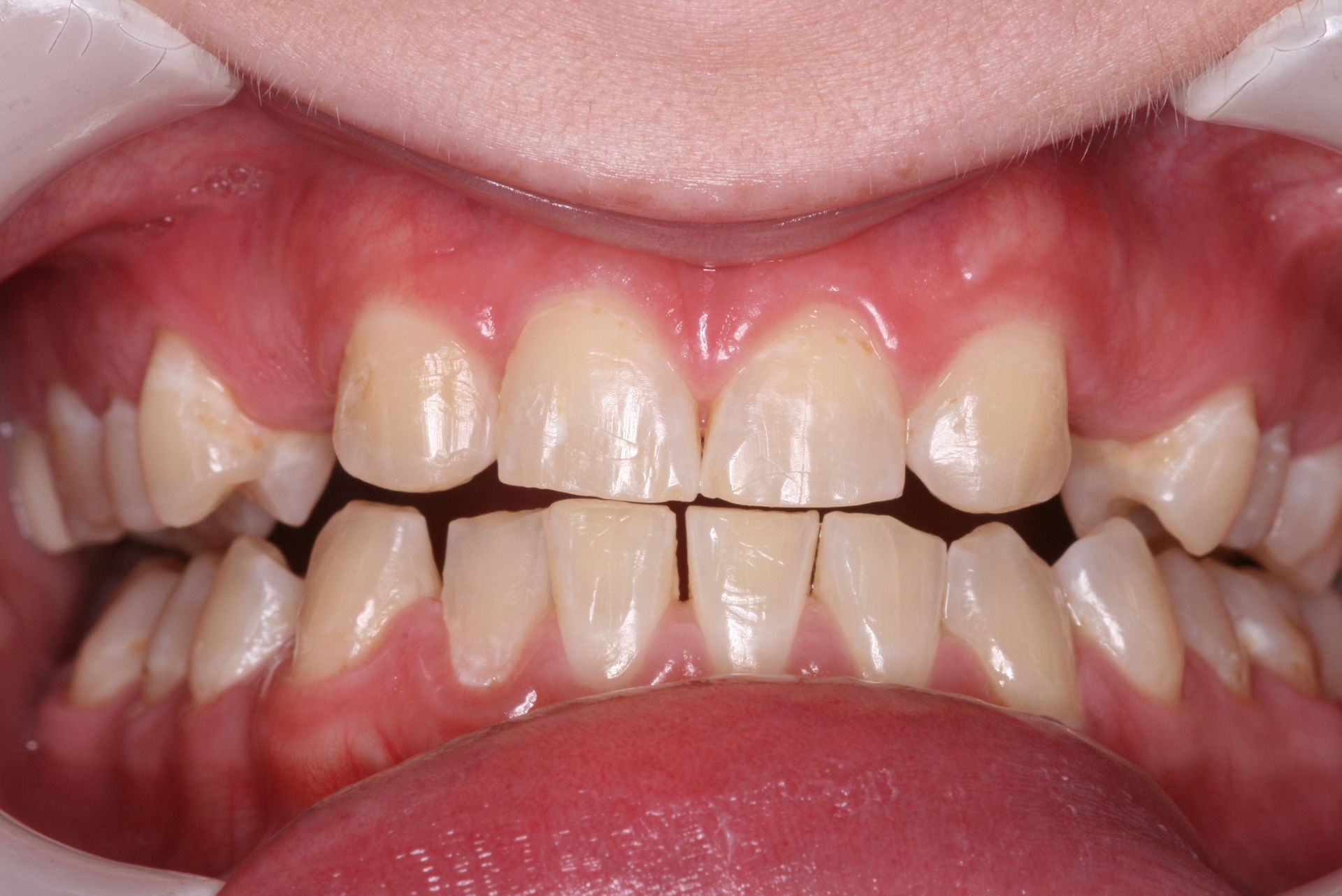 Close-up of human teeth, showing the upper and lower rows, slightly yellowed with a visible gum line.