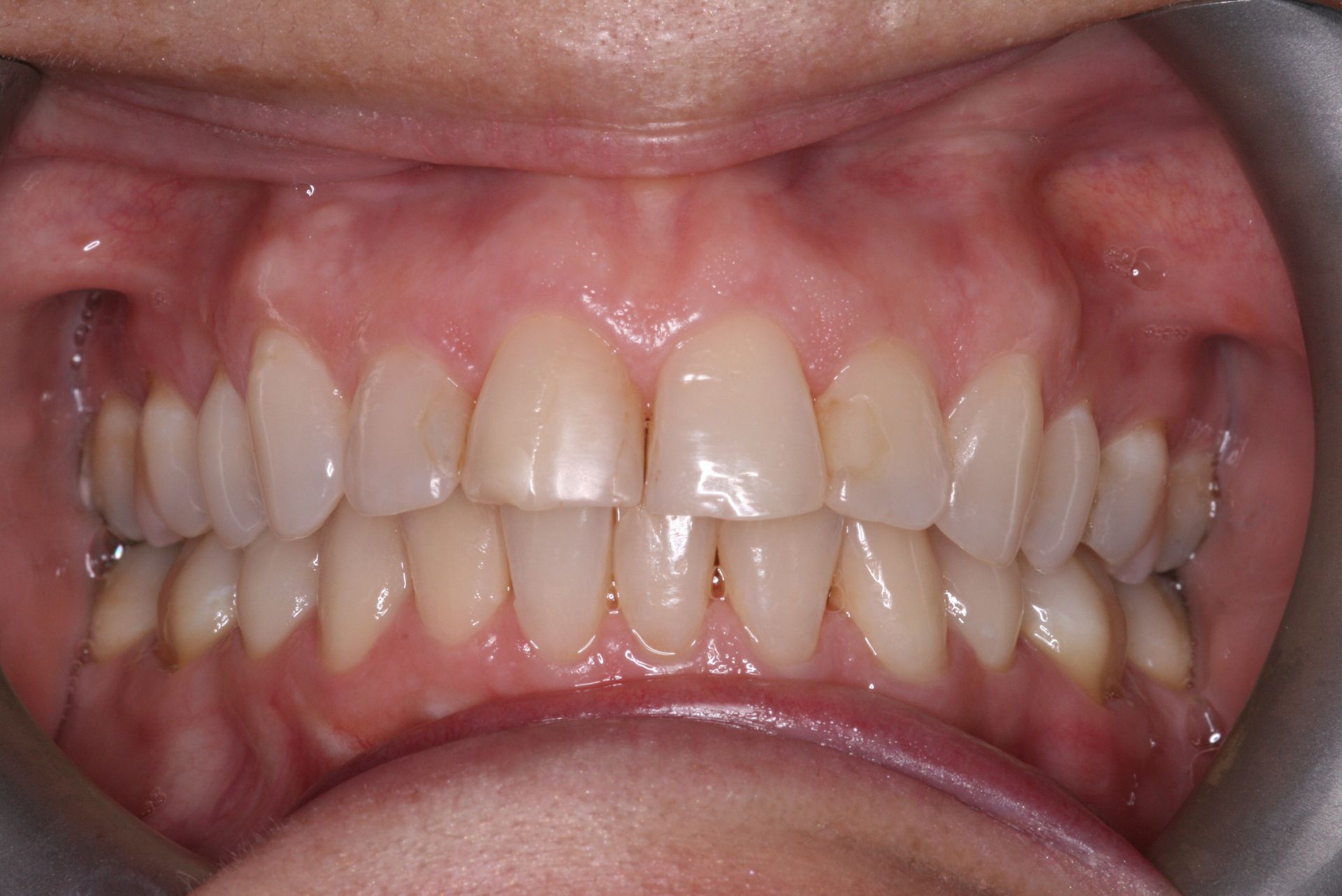 Close-up of human teeth, showing the upper and lower rows, slightly yellowed with a visible gum line.