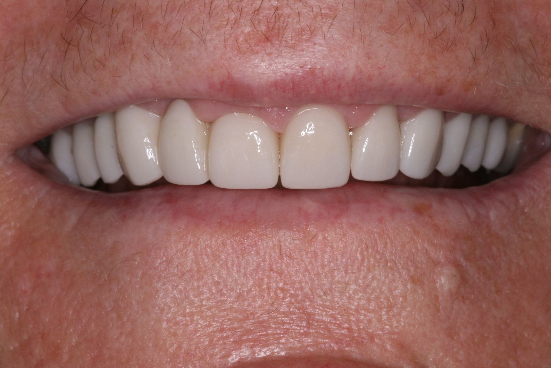 Close-up view of teeth and gums, light yellow teeth, pink gums.