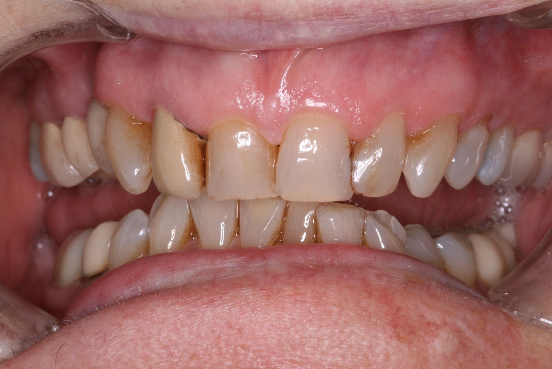 Close-up of human teeth, showing the upper and lower rows, slightly yellowed with a visible gum line.