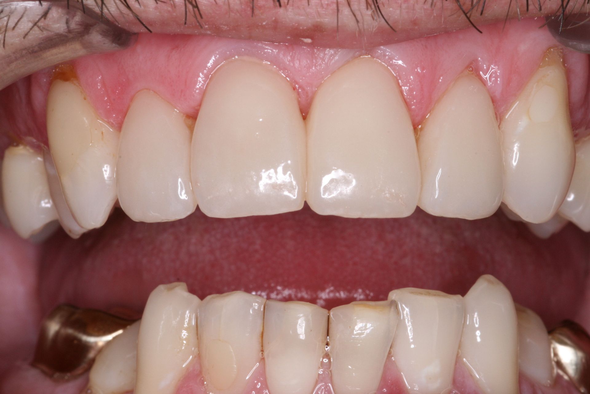 Close-up view of teeth and gums, light yellow teeth, pink gums.