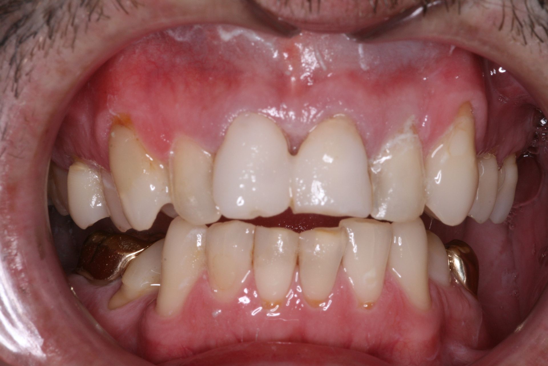 Close-up of human teeth, showing the upper and lower rows, slightly yellowed with a visible gum line.