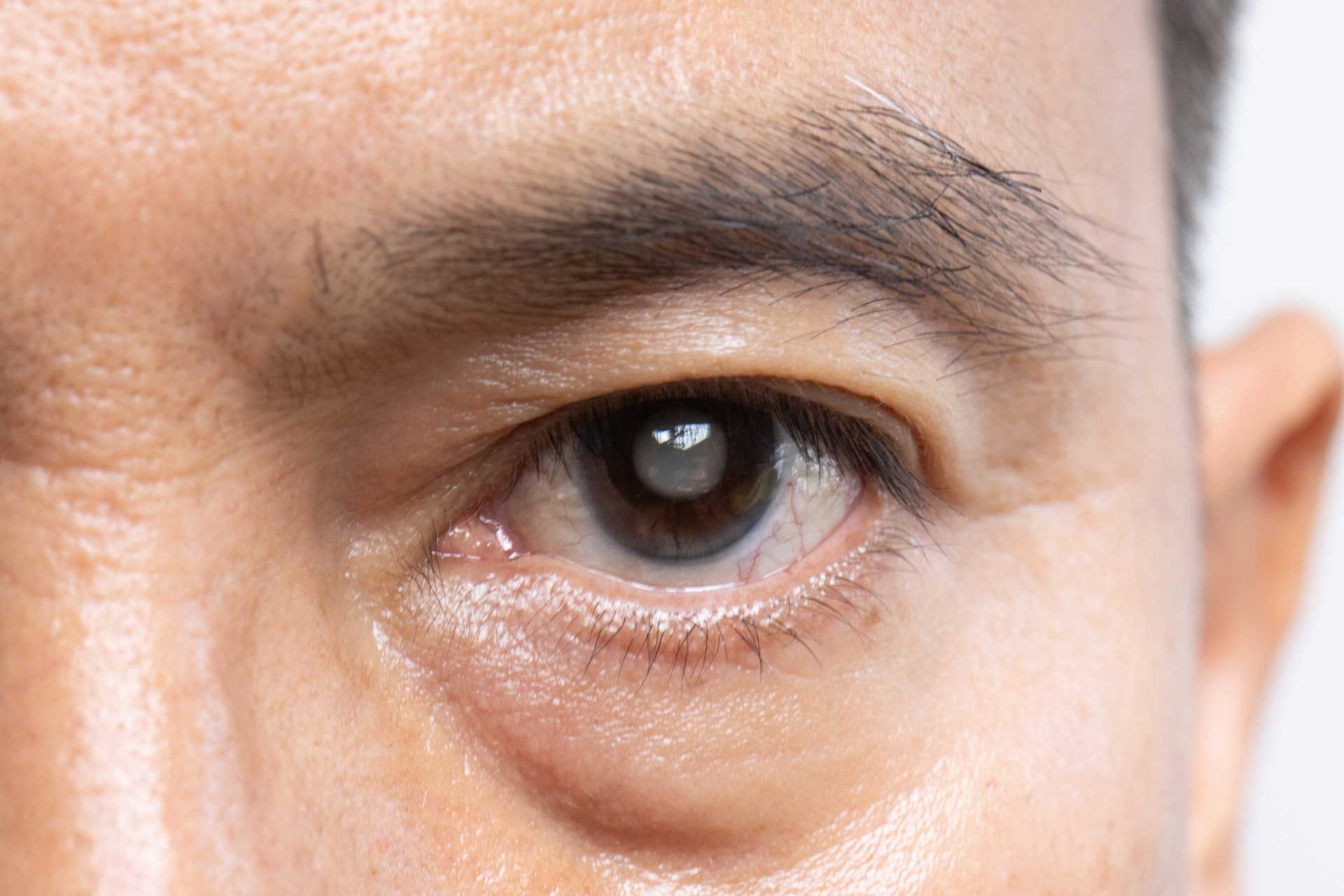 Close-up of a man's eye with a cataract, appearing cloudy and white within the dark pupil.