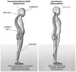 Side-by-side comparison of a patient’s posture before and after treatment with Therbo Side-by-side comparison of a patient’s posture before and after treatment with Therbo