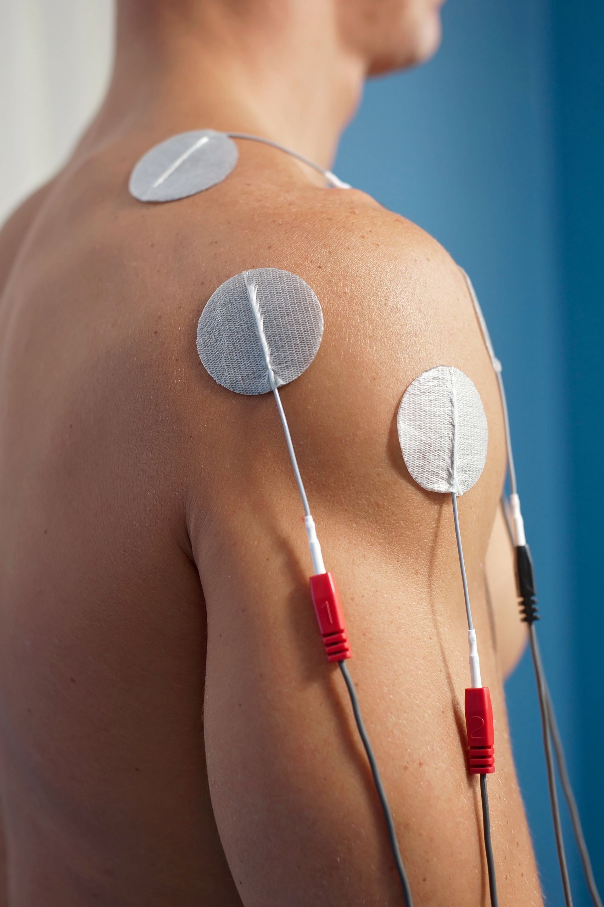 Man's bare shoulder with electrodes attached for therapy. Red and black wires connect to pads.