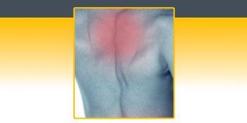 A close up of a person 's back with a red spot on it. A close up of a person 's back with a red spot on it.