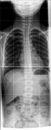 It is a black and white x-ray of a person 's chest and abdomen. It is a black and white x-ray of a person 's chest and abdomen.