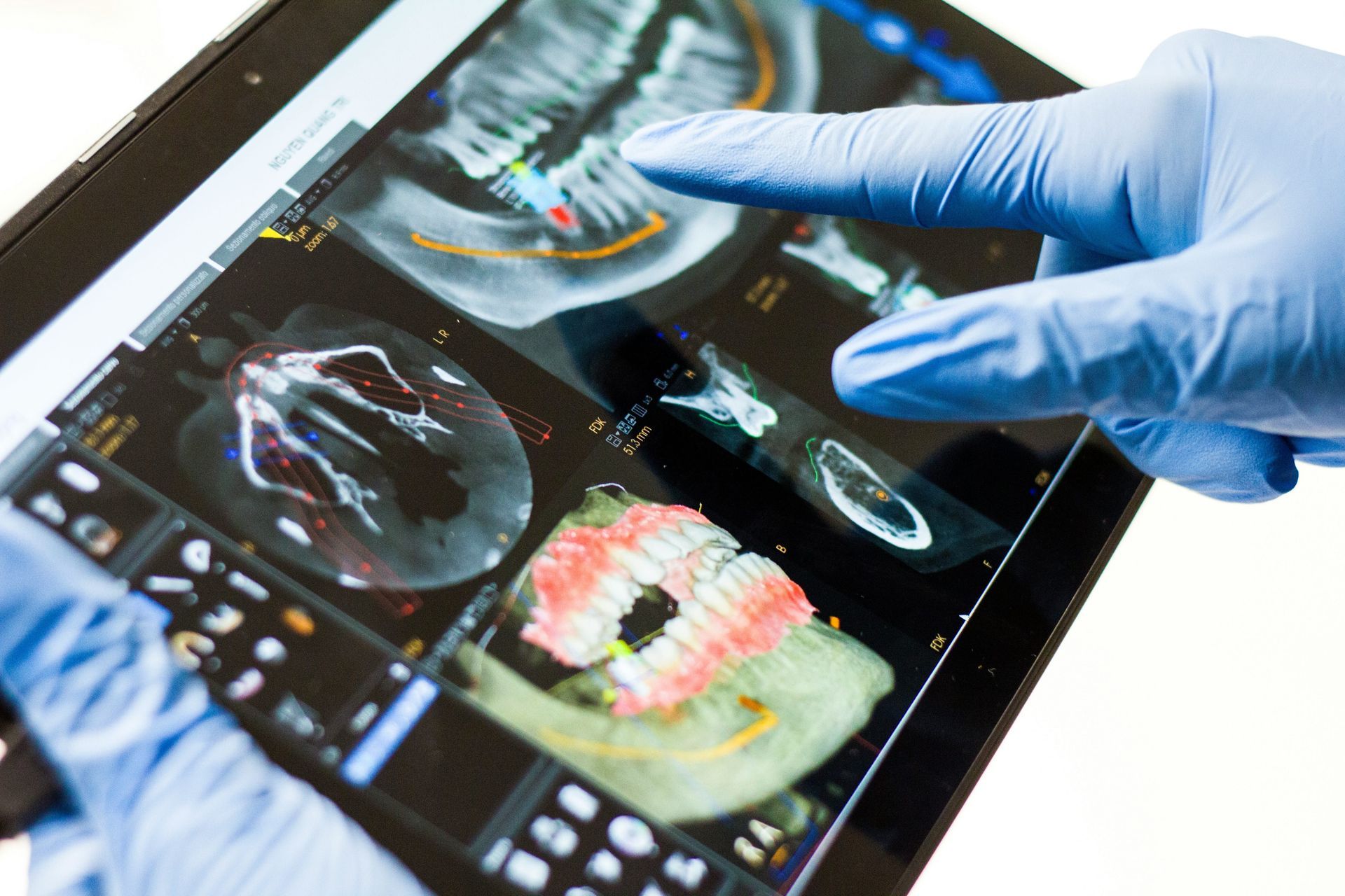 Gloved hands pointing at dental CT scan images on a tablet.