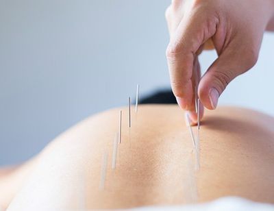 Acupuncture Treatment — Savage, MN — Hidden Valley Chiropractic:Michael E. Novak, D.C.