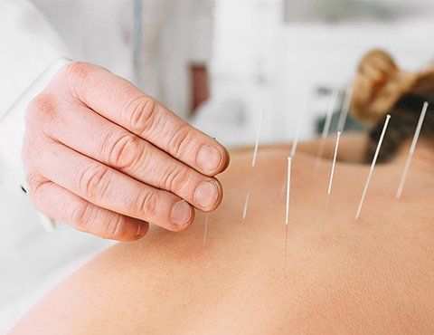 Acupuncture — Savage, MN — Hidden Valley Chiropractic:Michael E. Novak, D.C.
