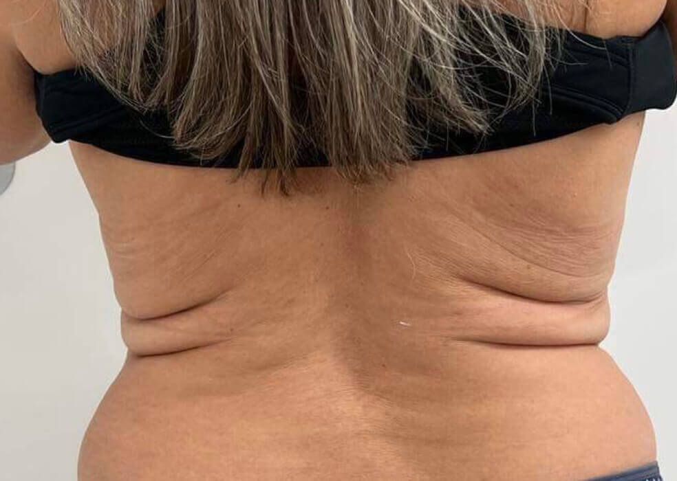 Before Back Belly Treatment — Cardiff, NSW — CosmoWorld