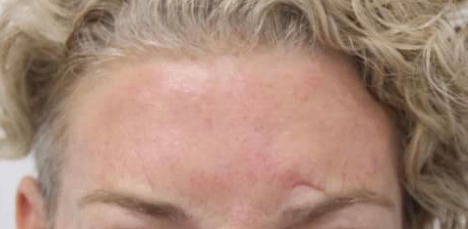 After Head Skin Treatment — Cardiff, NSW — CosmoWorld