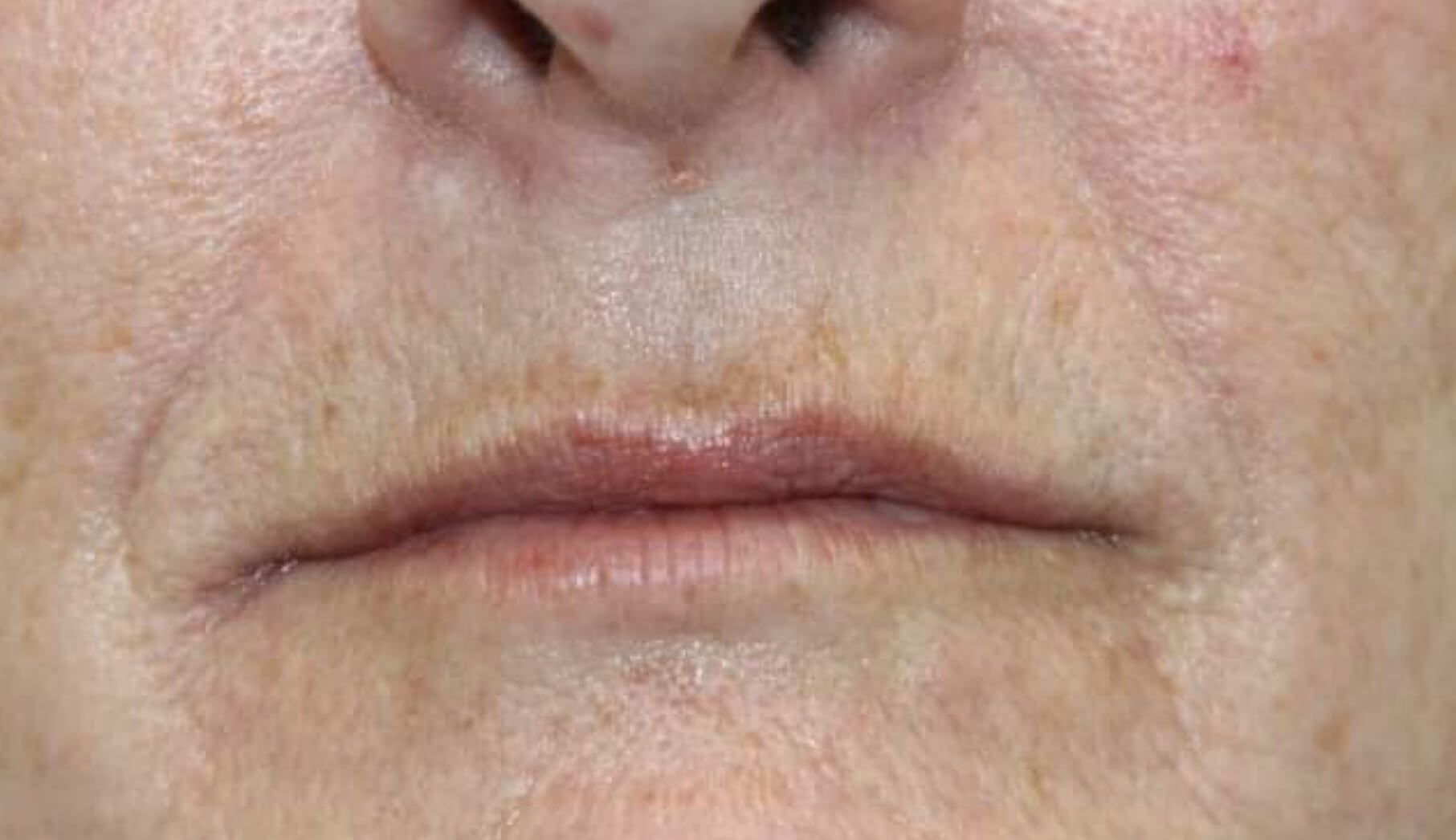 Before Male Lips Enhancement — Cardiff, NSW — CosmoWorld