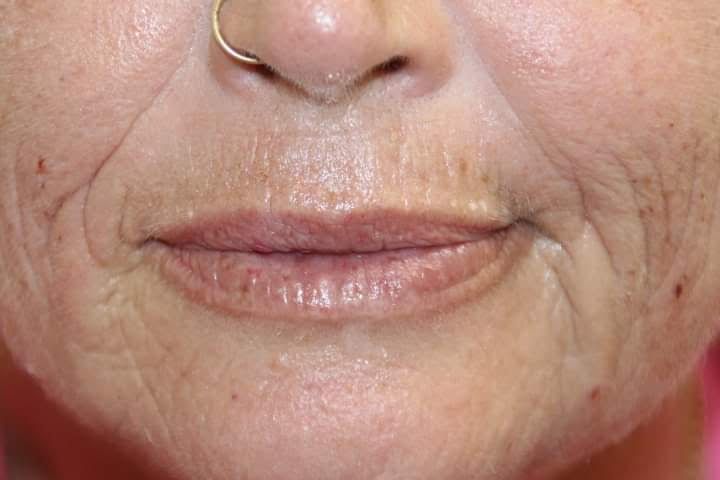 Before Female Lips Enhancement — Cardiff, NSW — CosmoWorld