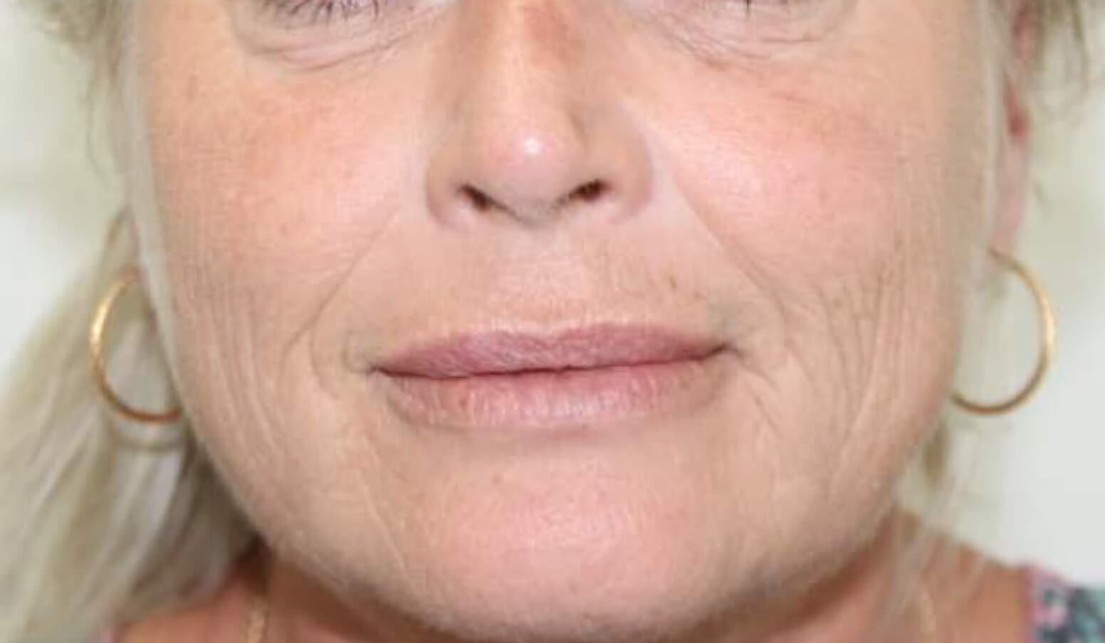 After Wrinkles Removal — Cardiff, NSW — CosmoWorld