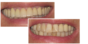A before and after picture of dental crowns