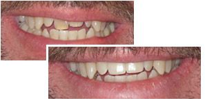 A before and after picture of dental implants, and crowns