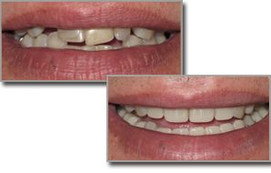 A before and after picture of dental dentures