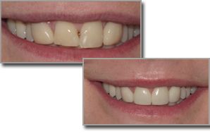 A before and after picture of dental veneers