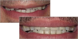 A before and after picture of dental crowns, and implants
