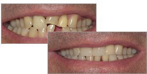A before and after picture of dental  veneers, crowns, and implants