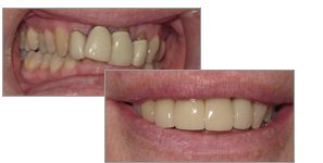 A before and after picture of dental crowns