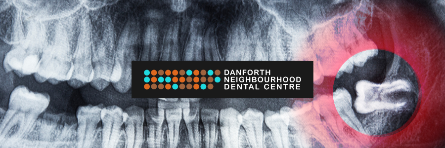 X-ray of teeth with Danforth Neighbourhood Dental Centre logo and close-up tooth with red background.