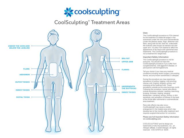 CoolSculpting Fat Freezing Flanks