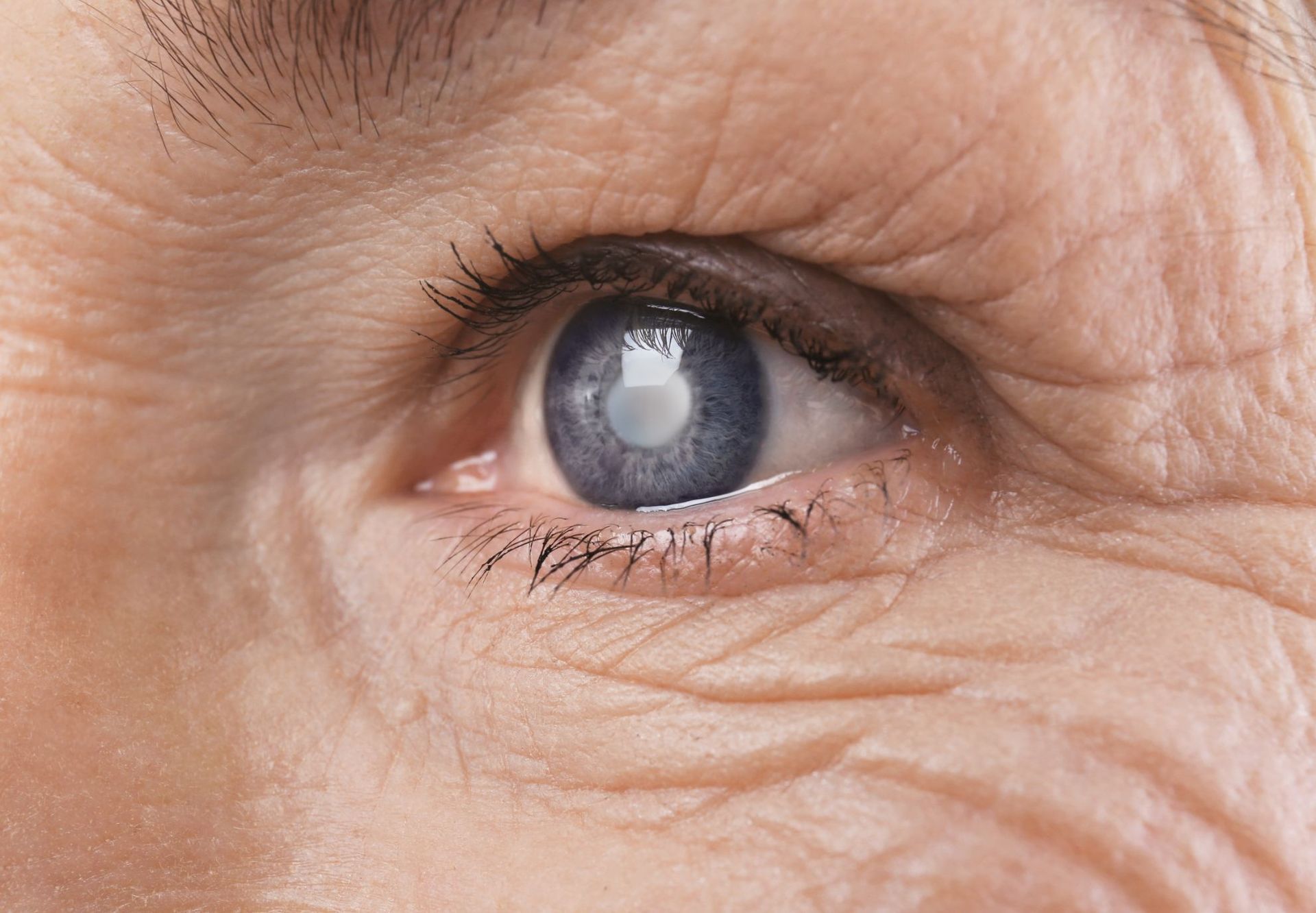 closeup of elderly woman eye with cataract