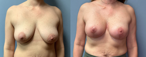 Associates in Plastic Surgery Breast Lift