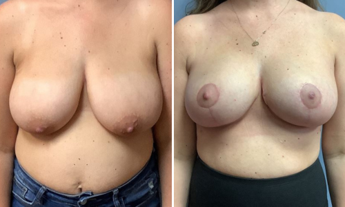 Associates in Plastic Surgery Breast Lift