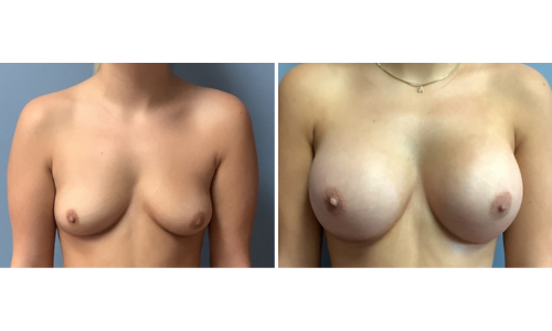 Associates in Plastic Surgery Breast Augmentation