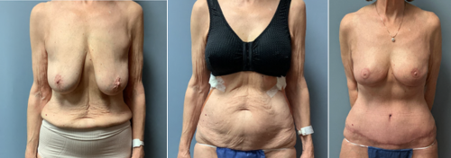 Associates in Plastic Surgery Breast Lift