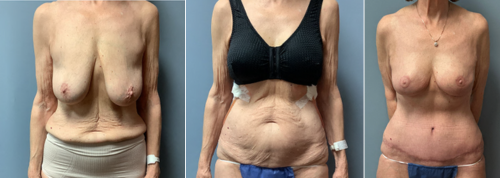 Associates in Plastic Surgery Mommy Makeover