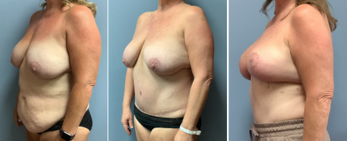 Associates in Plastic Surgery Mommy Makeover