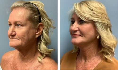 Associates in Plastic Surgery Brow Lift