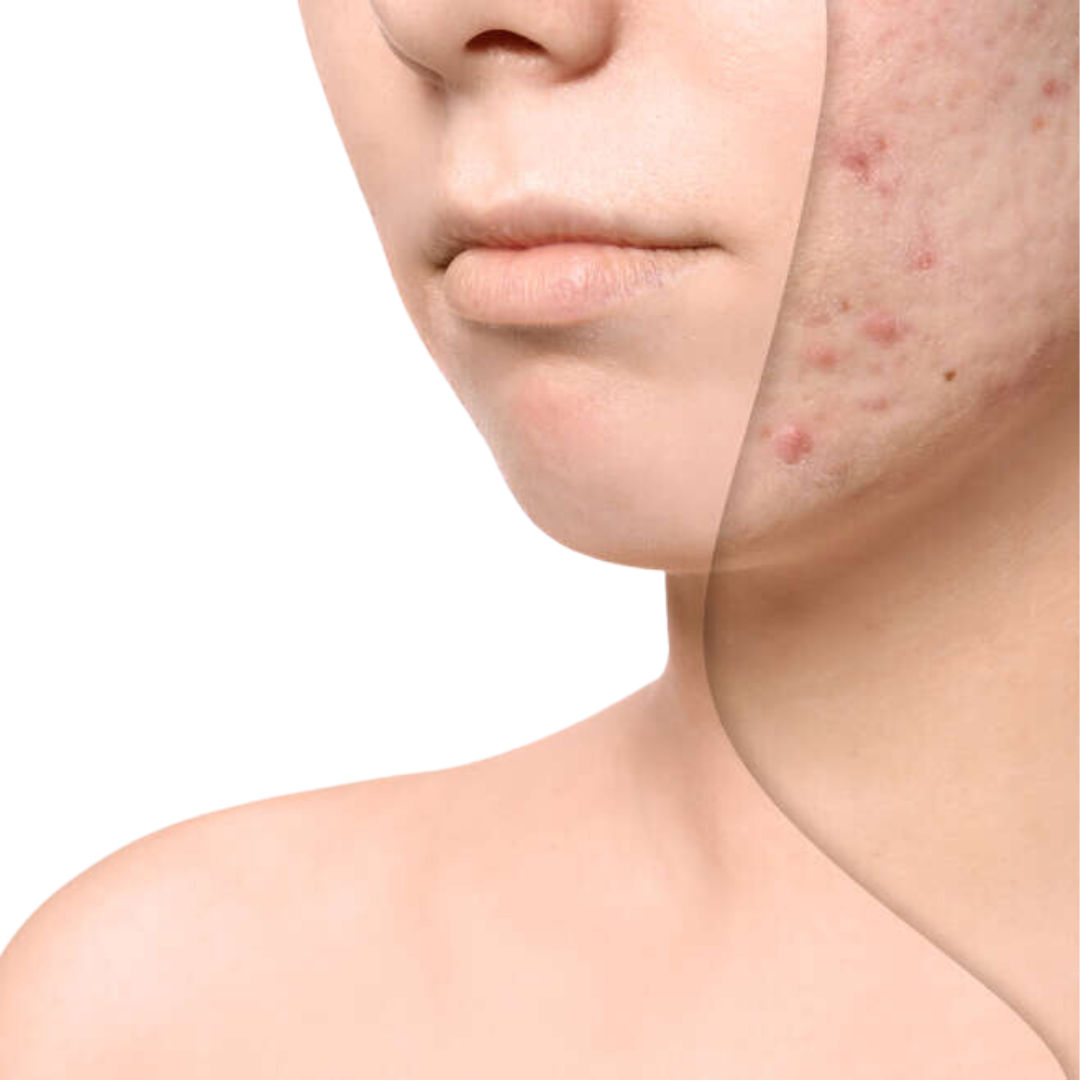 Before and after of a women who has has Steroid Acne Treatments