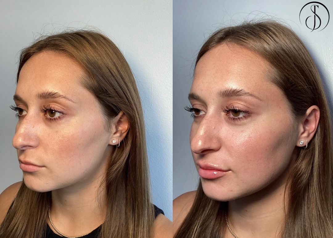 Woman's face before and after cosmetic procedure. Nose and lip enhancement. Side profile, fair skin.