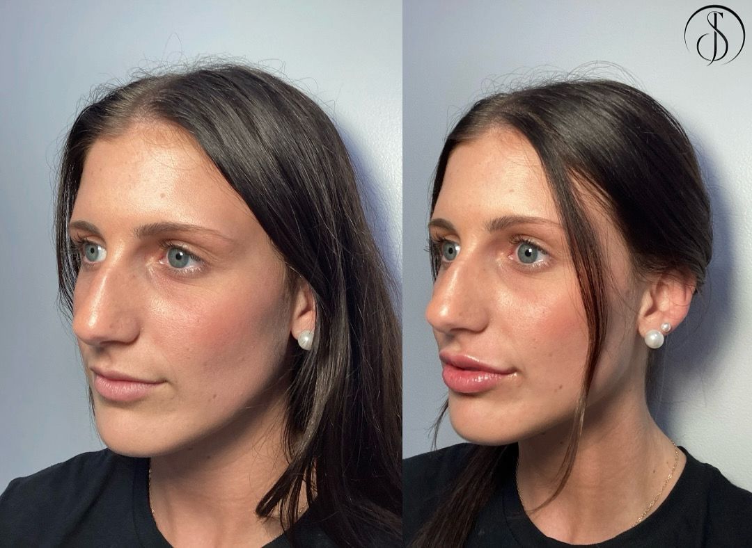 Side-by-side before-and-after portraits of a woman's face, showing a nose and lip enhancement.