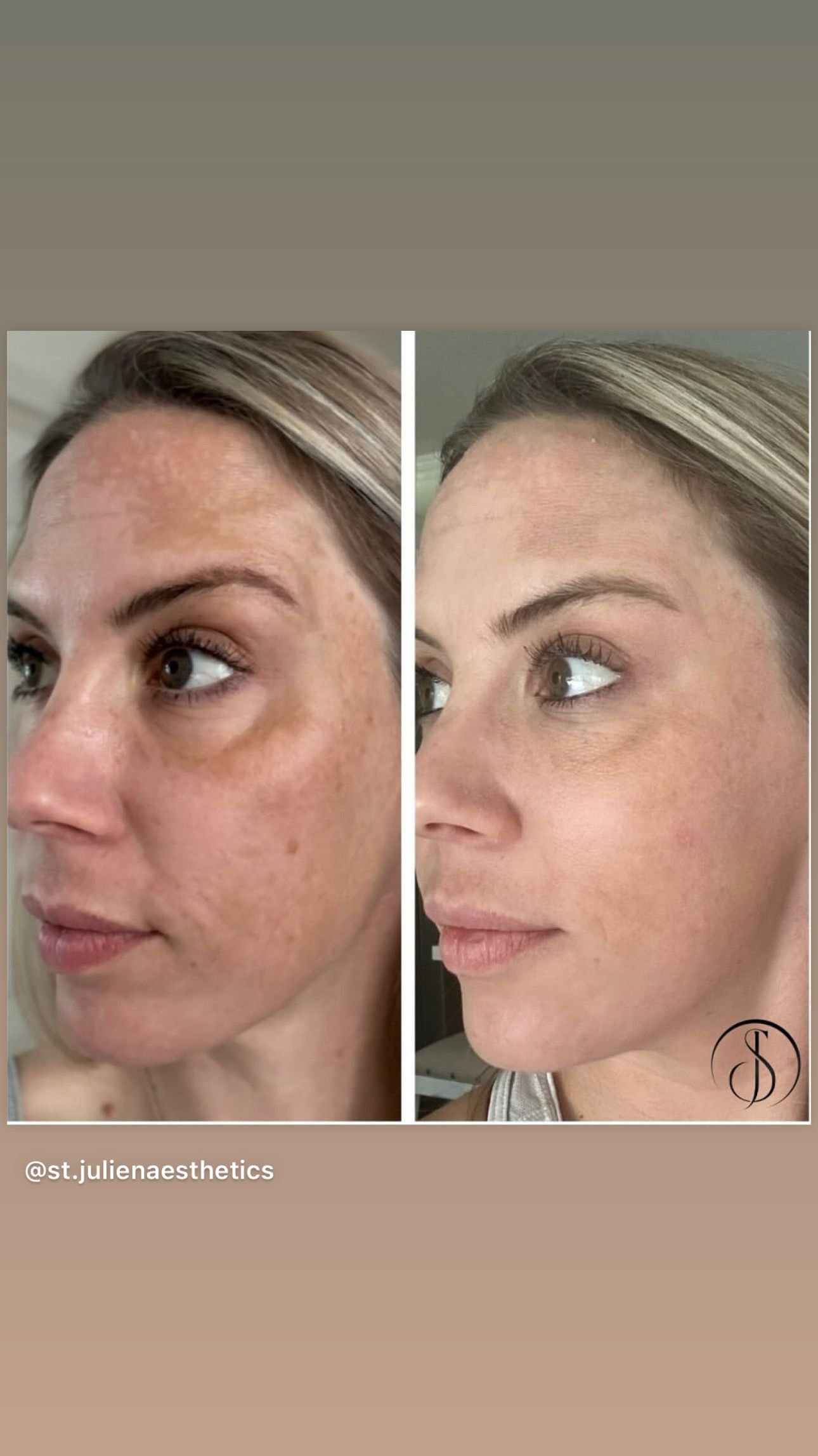 before and after photos showing reduction in dark spots, wrinkles, and improved skin tone.