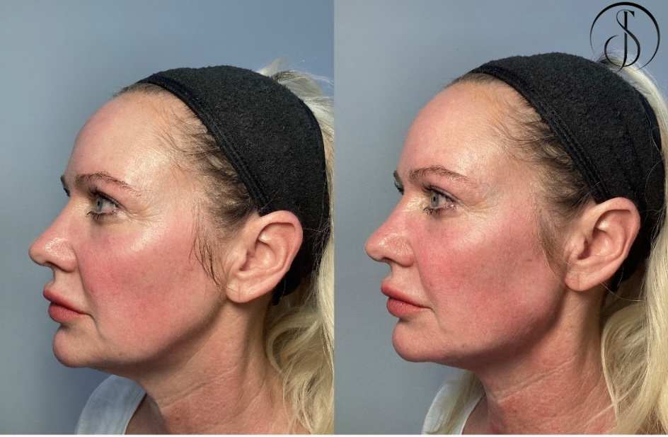 Side-by-side photos of a woman's face before and after a cosmetic procedure