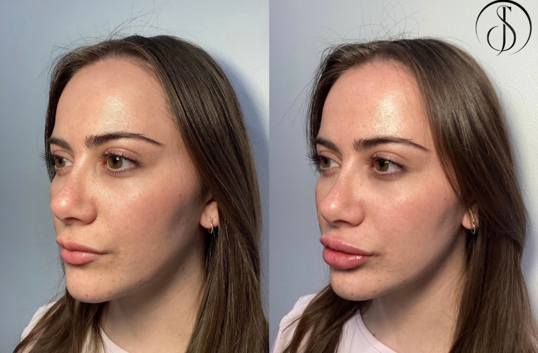 Two side-profile photos of a woman before and after lip filler injections.  She has fuller lips in the after photo.