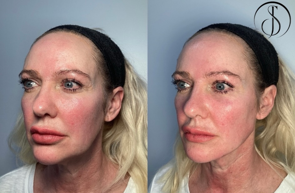 Before and after photos of a woman's face