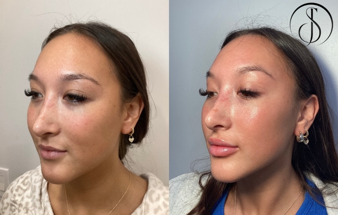 Side-by-side photos of a woman before and after cosmetic work; notably nose and lip enhancements.