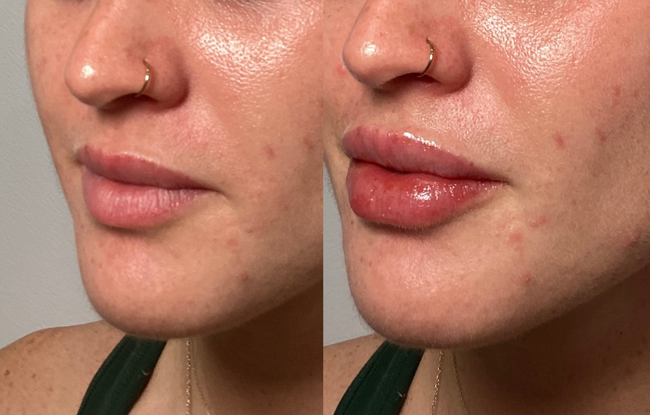Side-by-side comparison: woman's natural lips (left) vs. enhanced lips (right) with lip gloss.