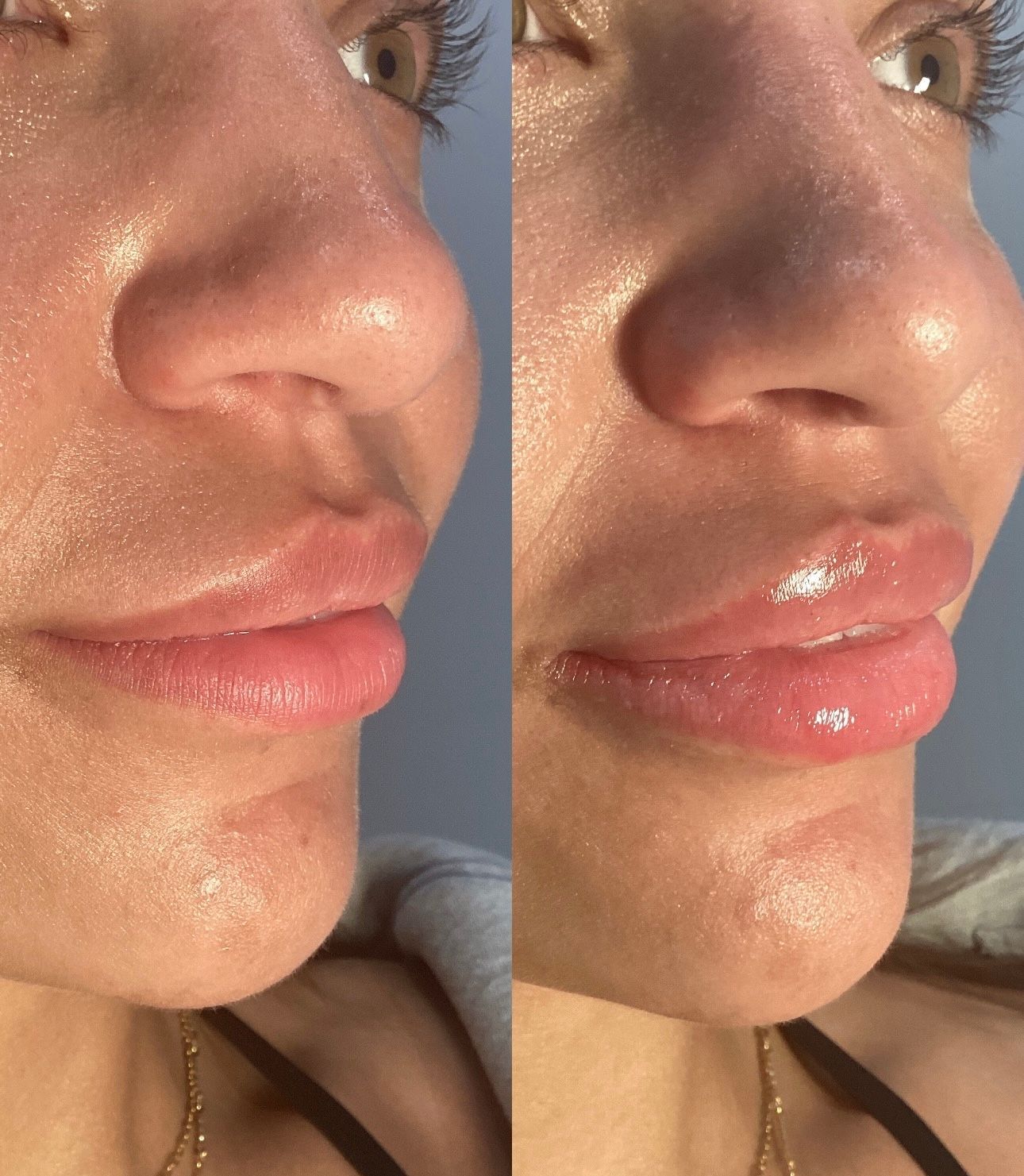 Two close-up photos of a woman's face, showing her lips before and after a cosmetic procedure.
