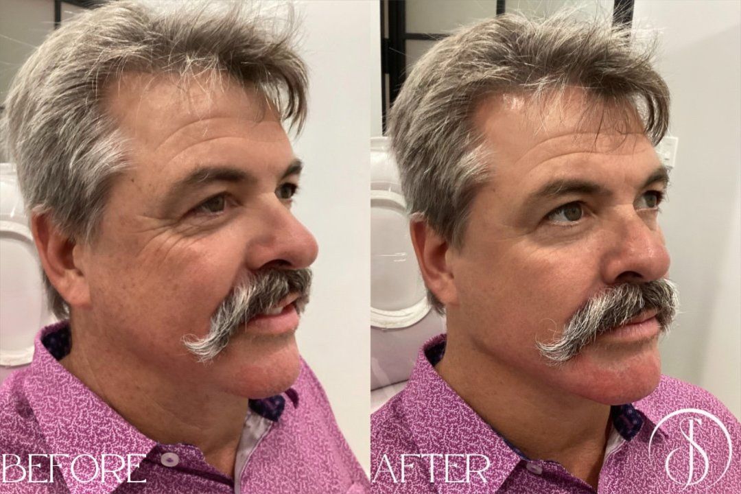 Man's face, before and after cosmetic work. Shows reduction in wrinkles and enhanced jawline.