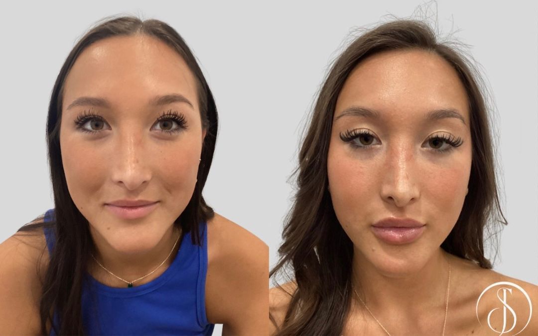 Side-by-side photos: Asian woman before and after cosmetic lip and cheek enhancements; neutral backdrop.