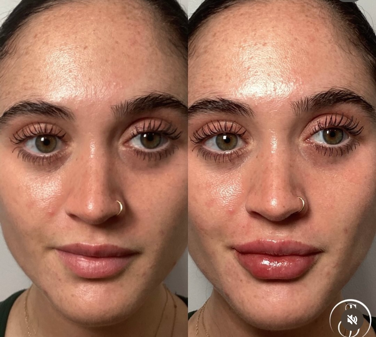 Side-by-side portraits of a woman before and after lip filler, with increased lip fullness.